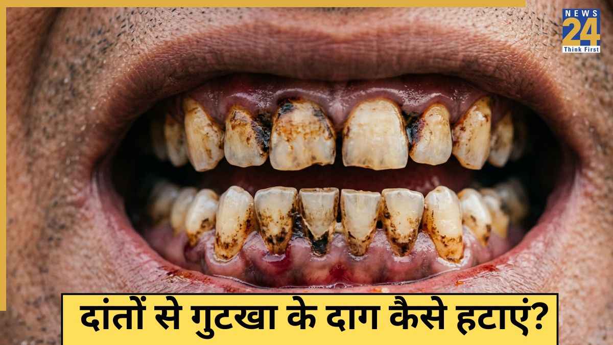 Gutkha Stain On Teeth