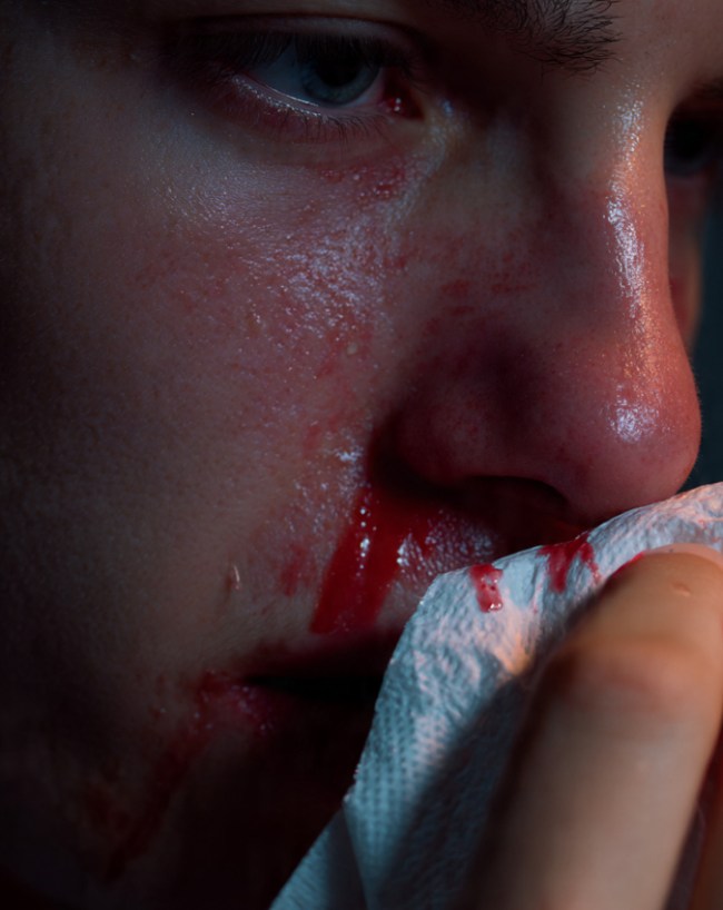 Hemophilia men Problem Bleeding-1-2-3-4-5-6-7-8