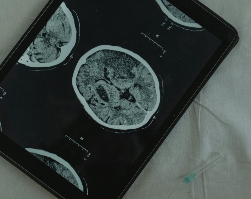 Brain Hemorrhage-1-2-3-4-5-6