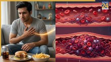 High Cholesterol In Young Adults