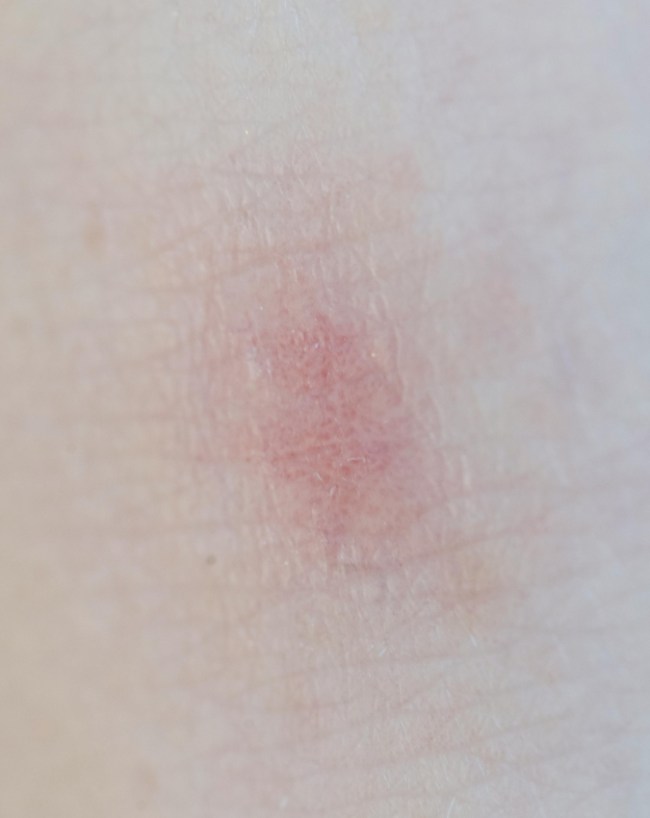 skin kitni degree mein jal jaati hai-1-2-3-4-5-6