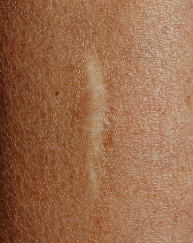skin kitni degree mein jal jaati hai-1-2-3-4-5-6-7