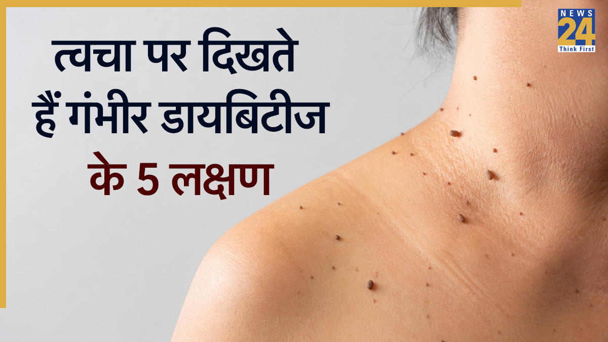 Diabetes gambhir hone ke lakshan