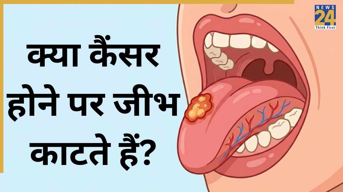 Tongue cancer treatment-1