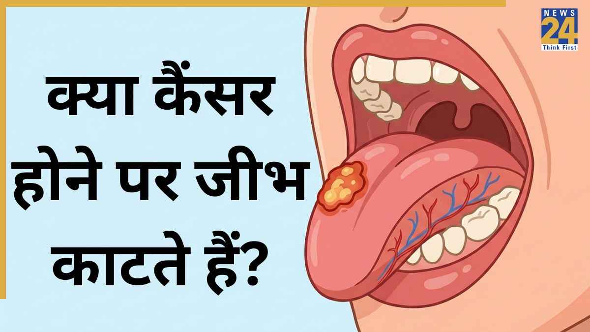 Tongue cancer treatment