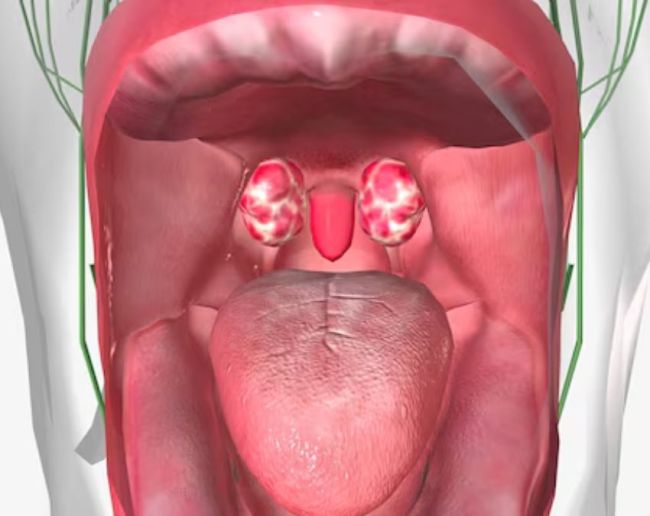 Throat Sores-1-2-3