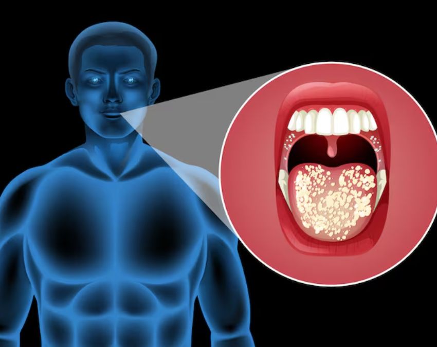 Throat Sores-1-2-3-4-5
