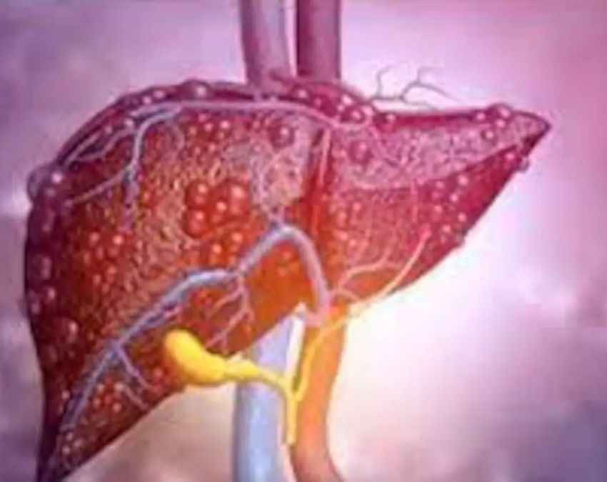 लिवर कैंसर की आखिरी स्टेज क्या होती है? 