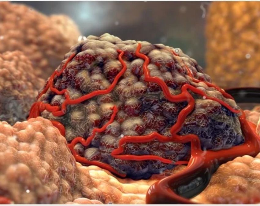 early cancer detection-1-2