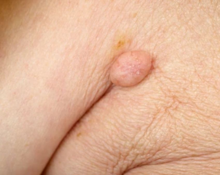 early cancer detection-1-2-3