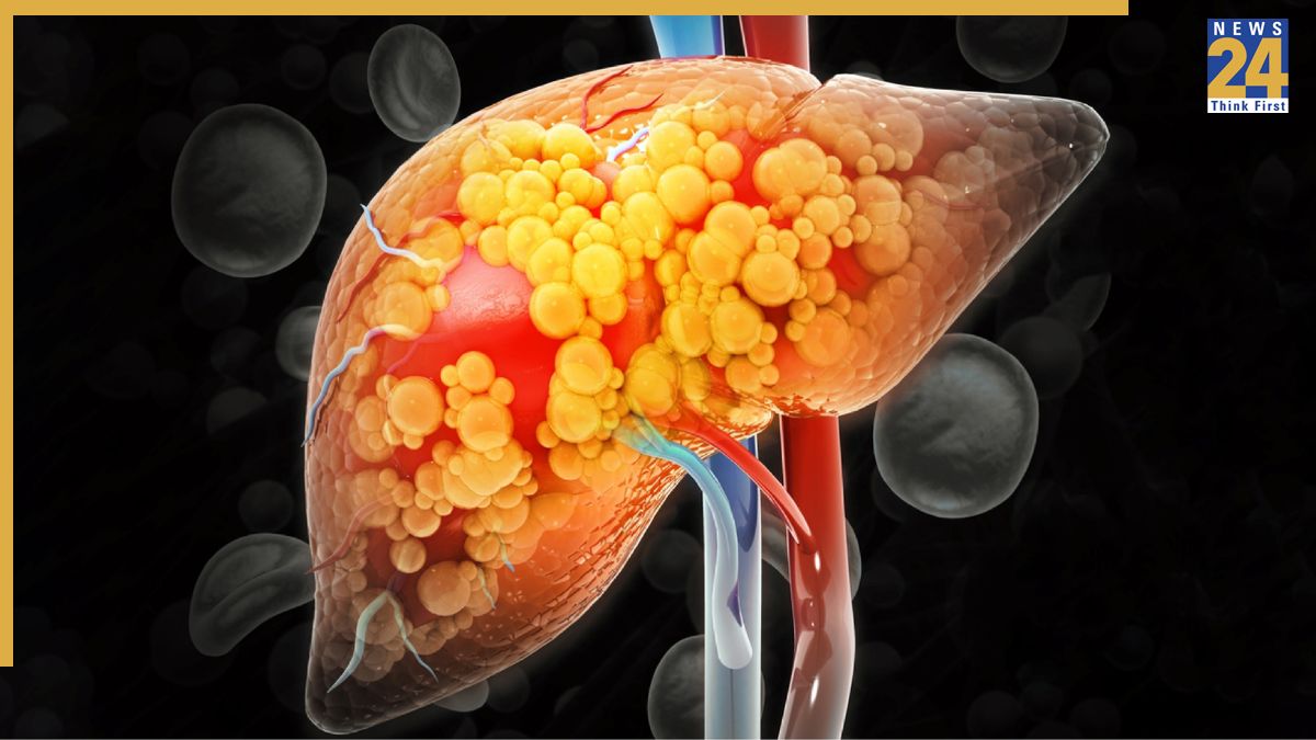 Fatty Liver Problem Fatty Liver Problem-1