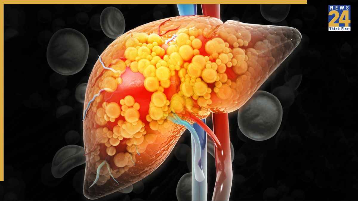 Fatty Liver Problem