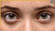 Eye Diseases Glaucoma