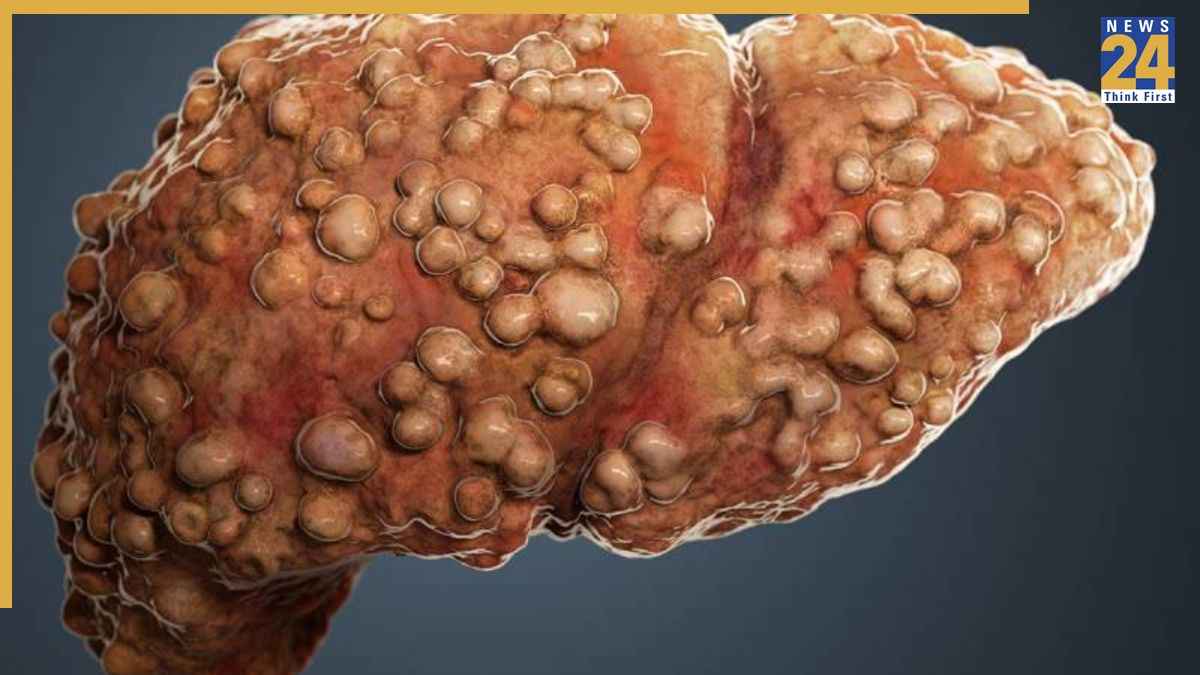 Cirrhosis of the Liver Cirrhosis of the Liver