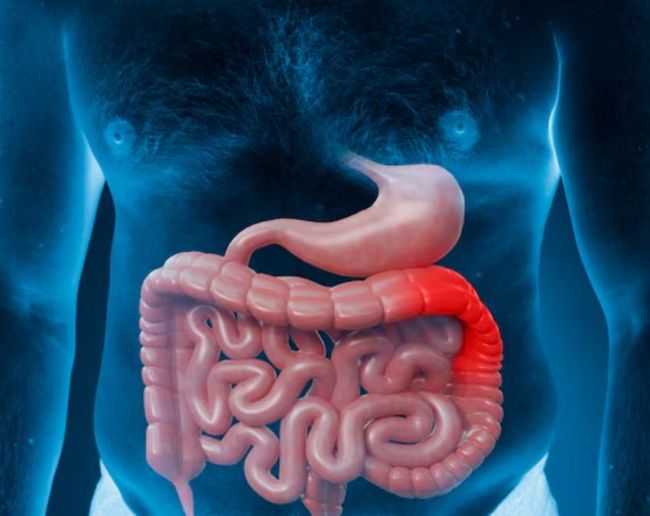 Intestinal Inflammation-1-2-3