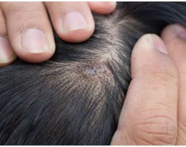 Forehead Pimples-1-2-3