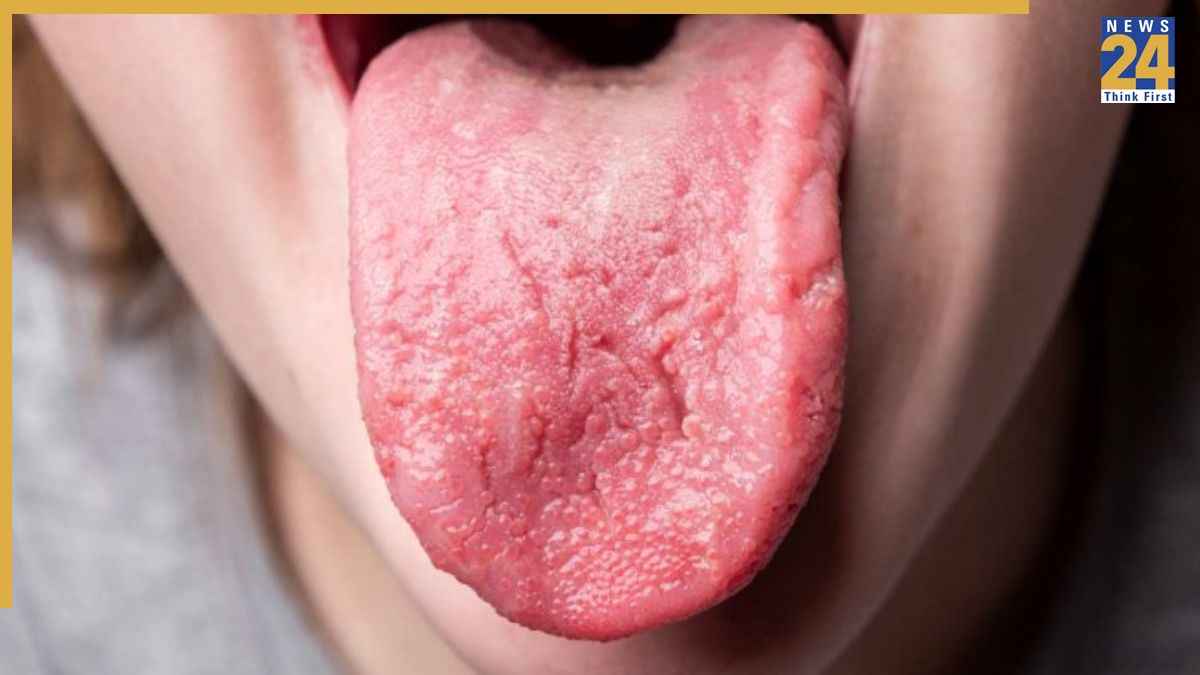 Vitamin B12 Deficiency
