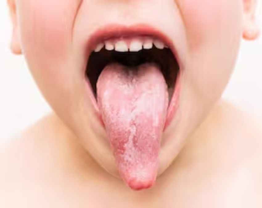 B12 की कमी में जीभ कैसी दिखती है?