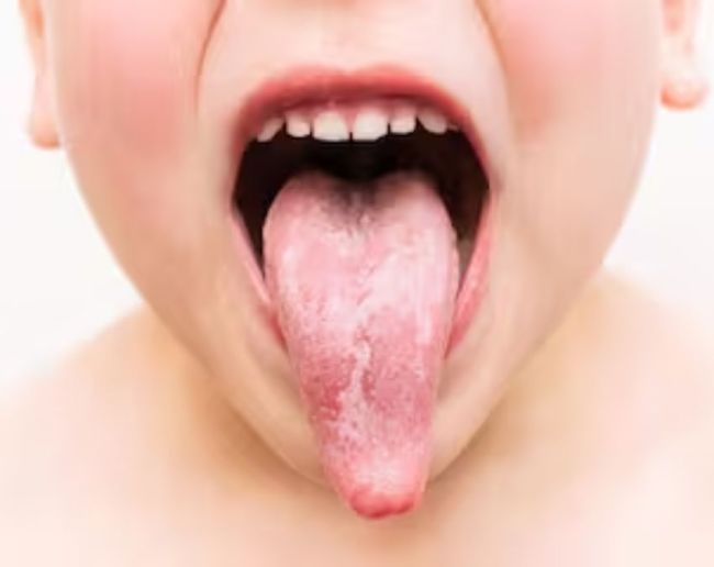 Vitamin B12 Deficiency-1-2