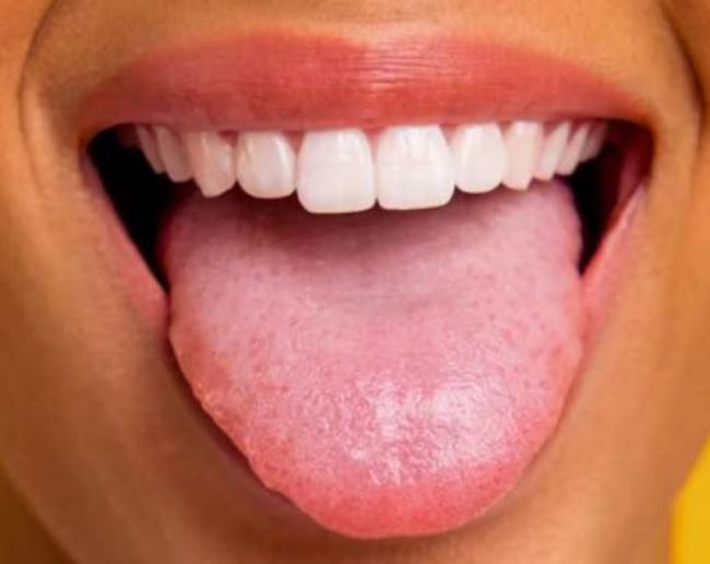 Vitamin B12 Deficiency-1-2-3-4