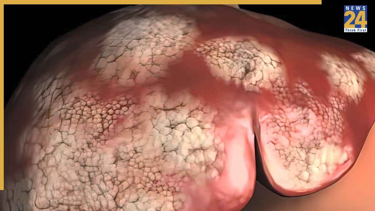 Liver Cancer Ki Last Stage Liver Cancer Ki Last Stage