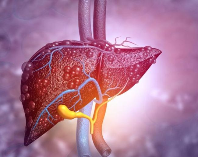 Liver Cancer Ki Last Stage-1-2