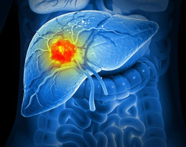 Liver Cancer Ki Last Stage-1-2-3