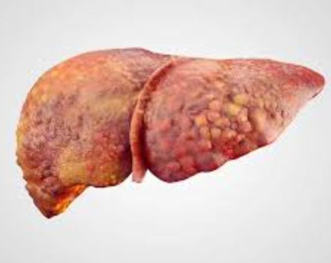 Liver Cancer Ki Last Stage-1-2-3-4
