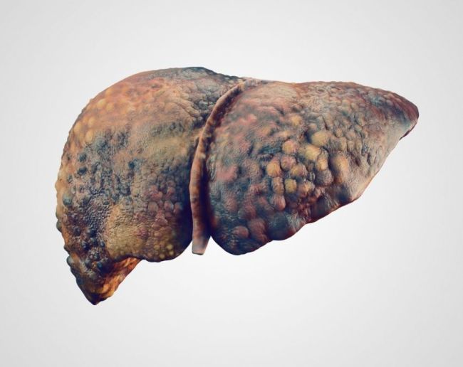 Liver Cancer Ki Last Stage-1-2-3-4-5