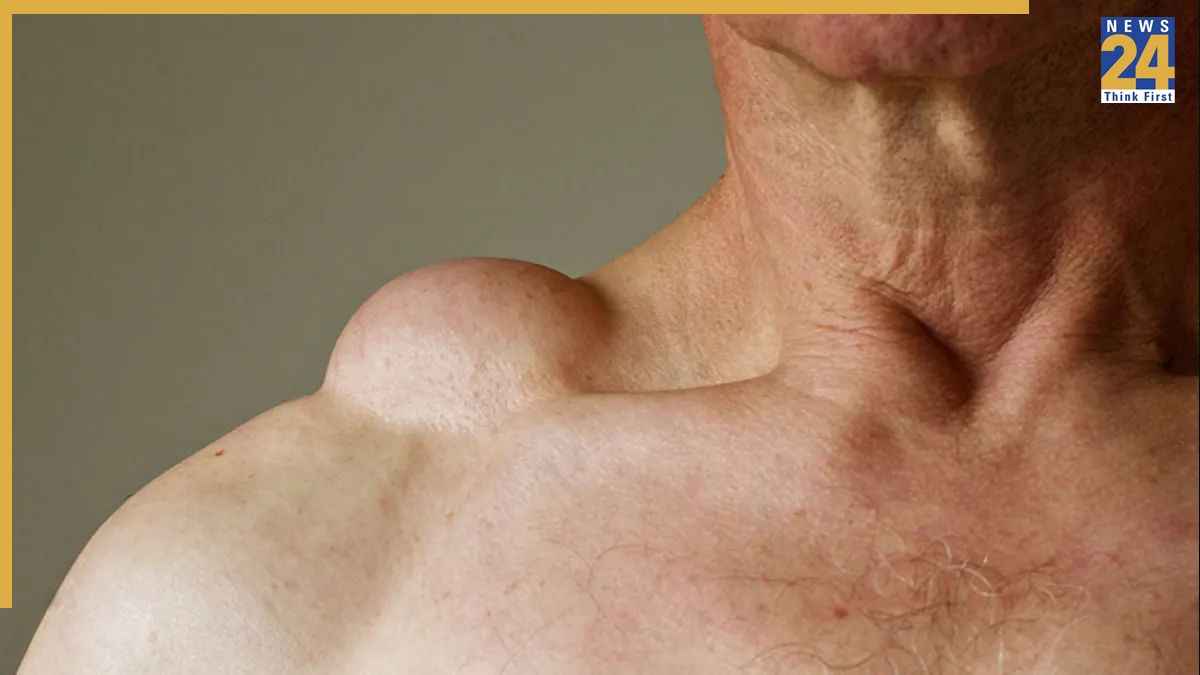 vitamin deficiency lumps