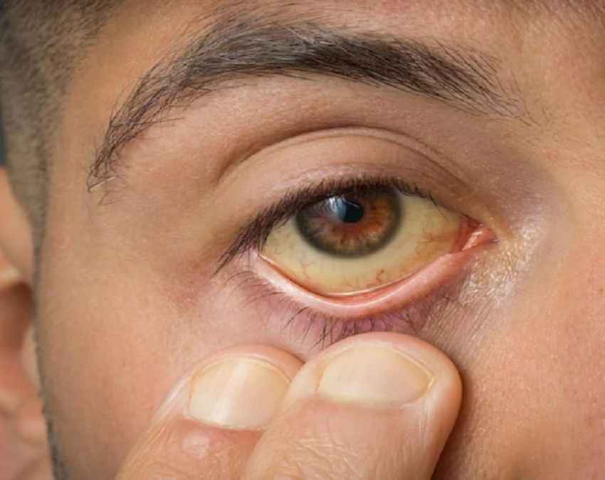 आंसू की नली ब्लॉक होना