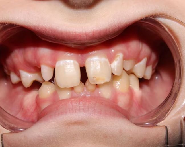 Teeth Grinding Reasons-1-2-3-4-5