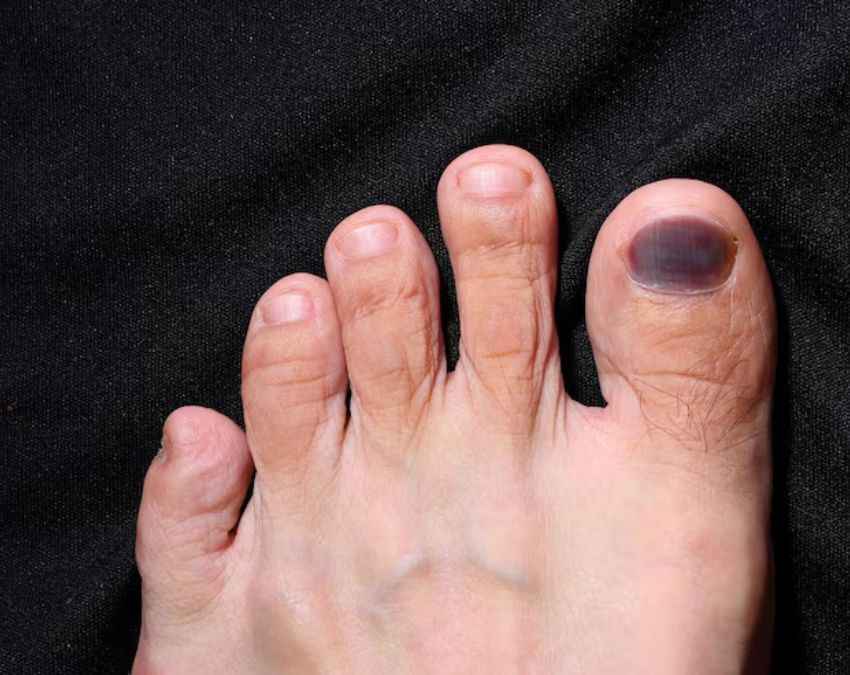 पैरों के घाव जल्दी ना भरना 