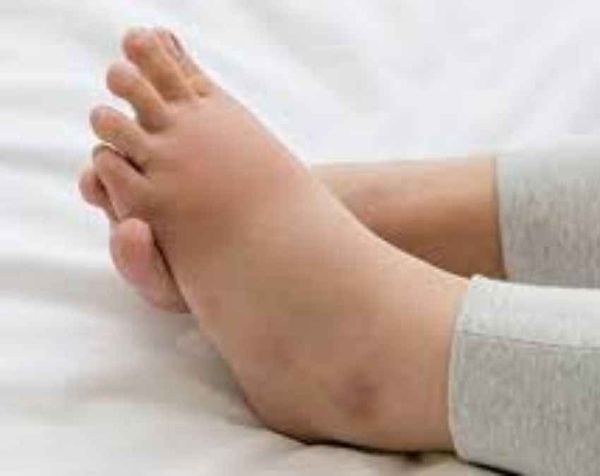 पैर में सूजन होना 