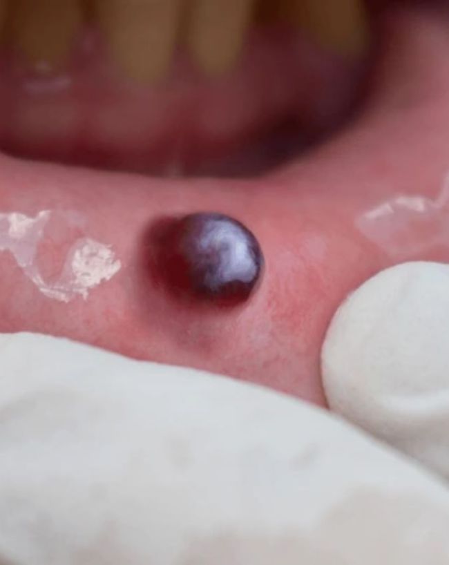 which vitamin deficiency causes mouth ganth-1-2