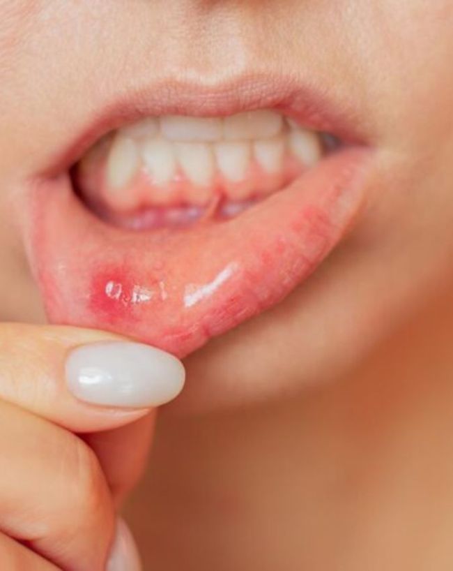 which vitamin deficiency causes mouth ganth-1-2-3