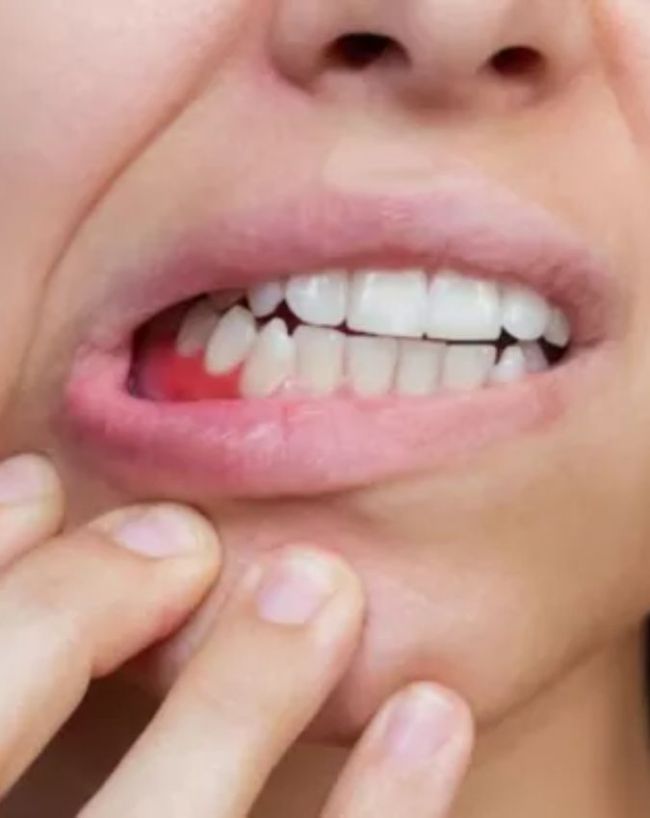 which vitamin deficiency causes mouth ganth-1-2-3-4-5