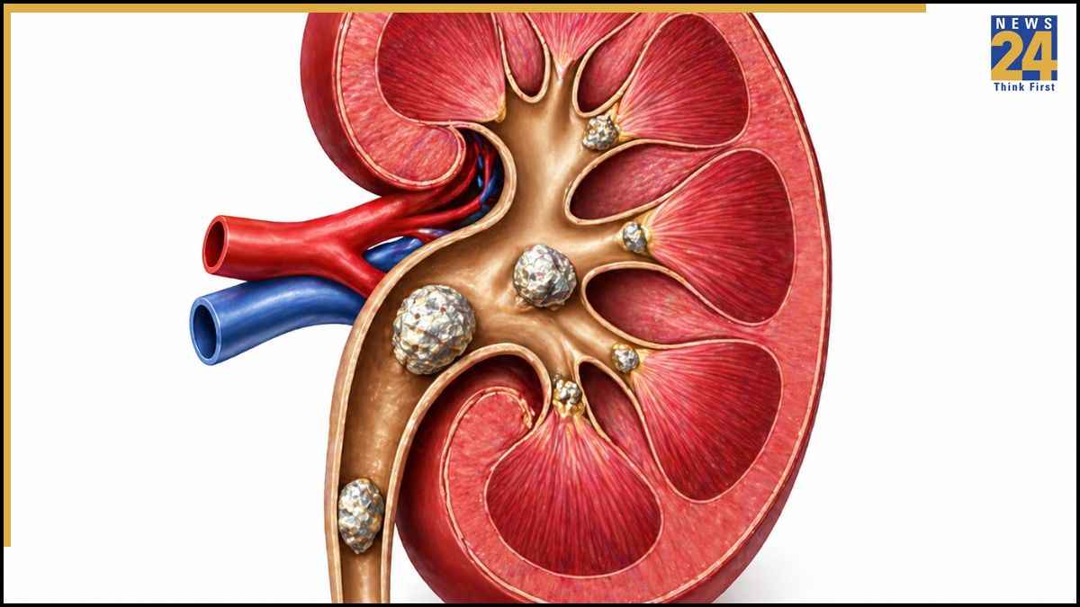 किडनी स्टोन से पहले शरीर देता है ये संकेत, कहीं आप तो नहीं कर रहे इग्नोर?