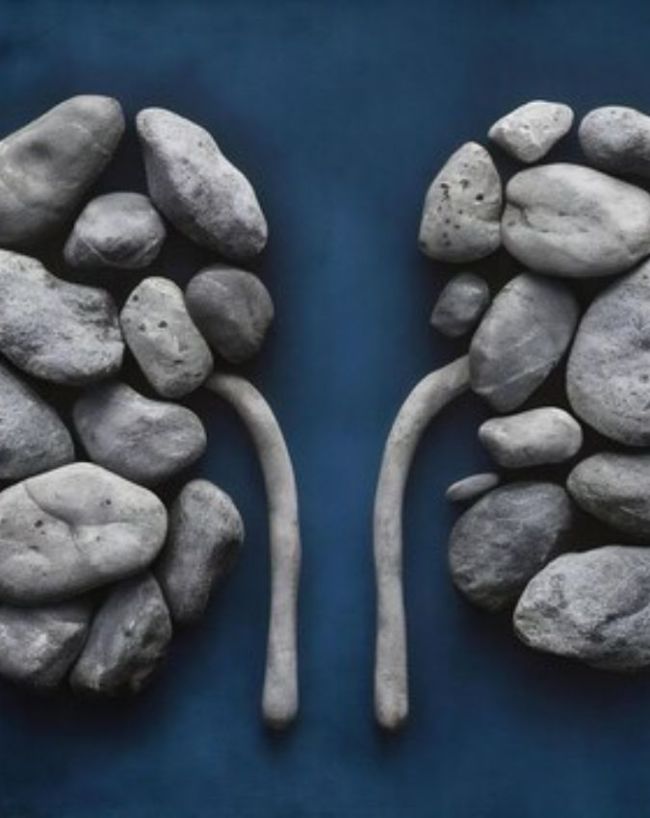 Kidney Stone Symptoms-1-2-3-4-5