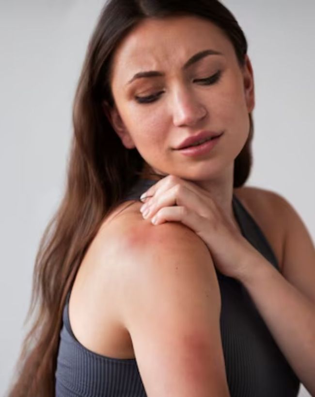 how soon does heat rash go away-1-2