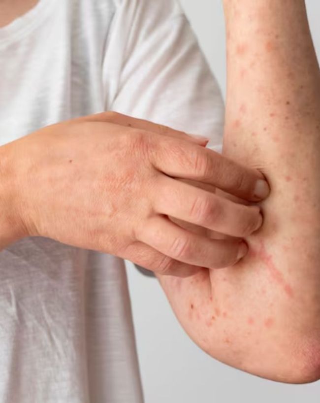 how soon does heat rash go away-1-2-3