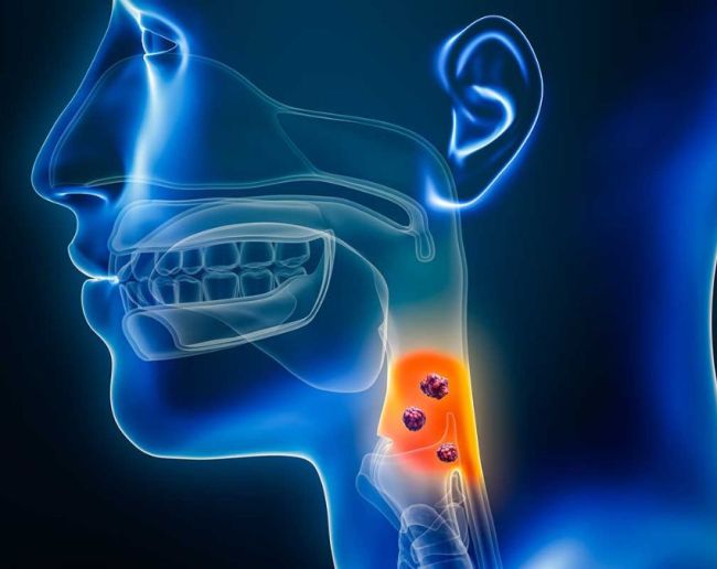 Throat Cancer Signs-1-2-3-4