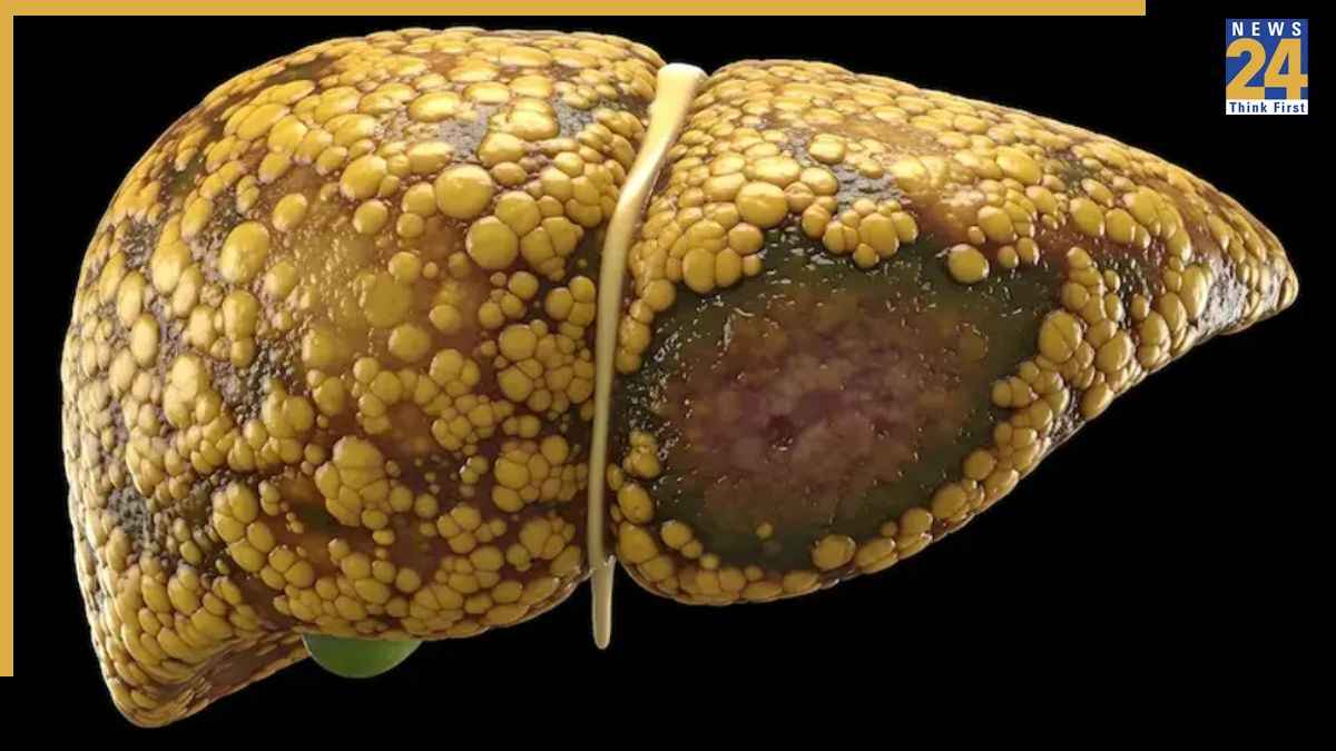 Fatty Liver Ki Pehli Stage