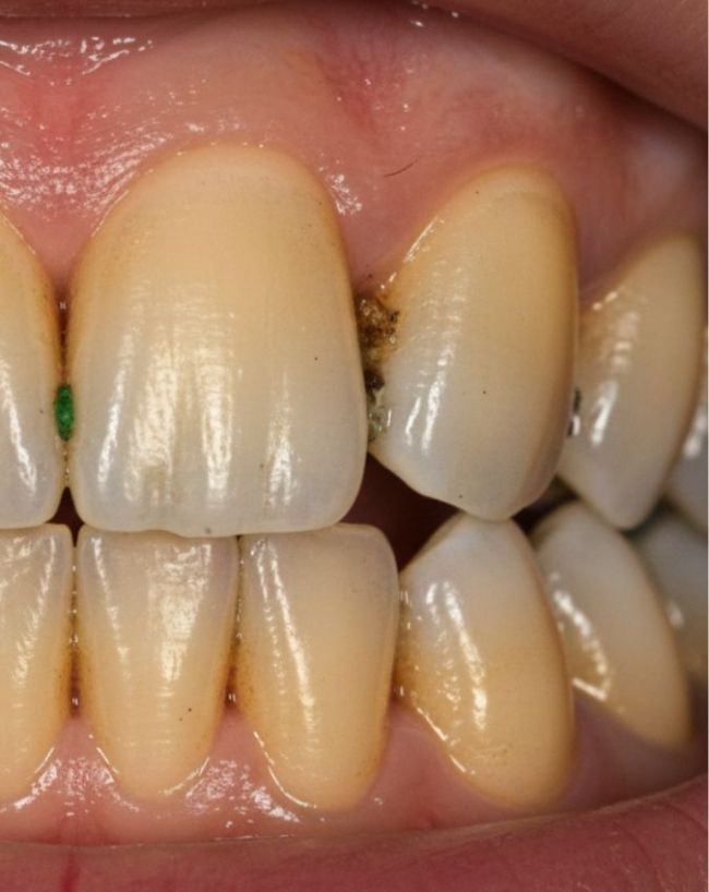 morning headache reason-1-2-3-4