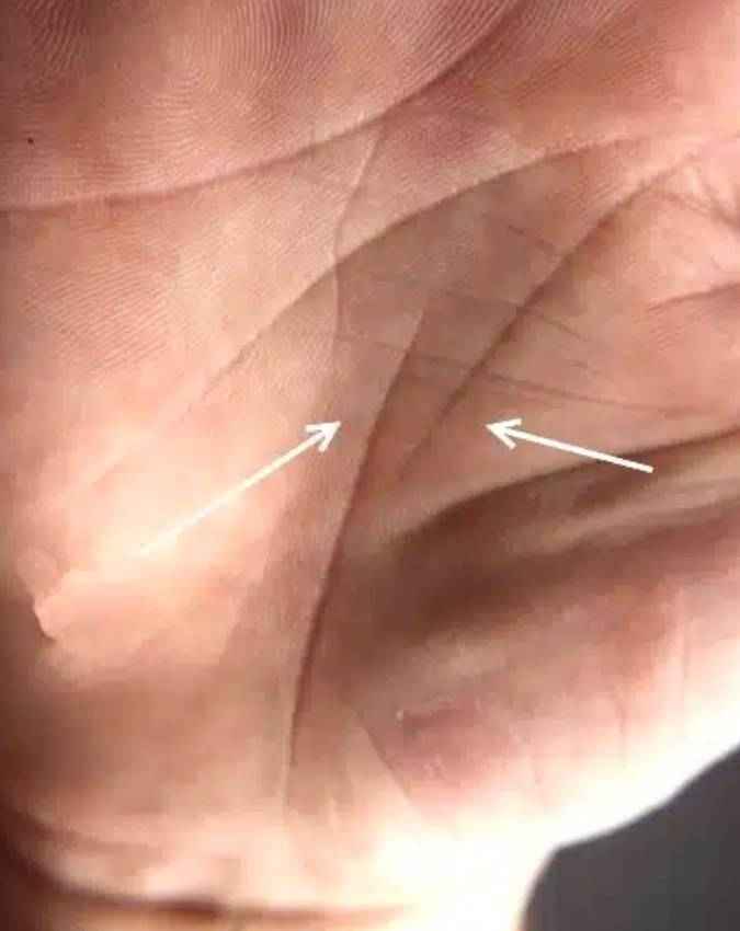 टूटी जीवन रेखा का संकेत