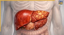 liver Cirrhosis