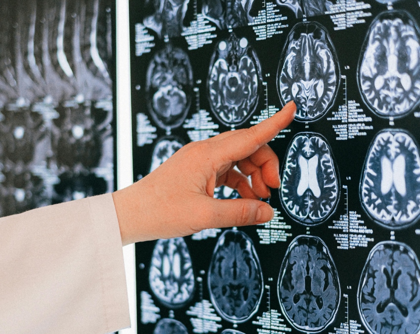 Brain Hemorrhage-1-2-3-4-5-6-7-8-9-10