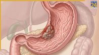 Stomach cancer symptoms in hindi