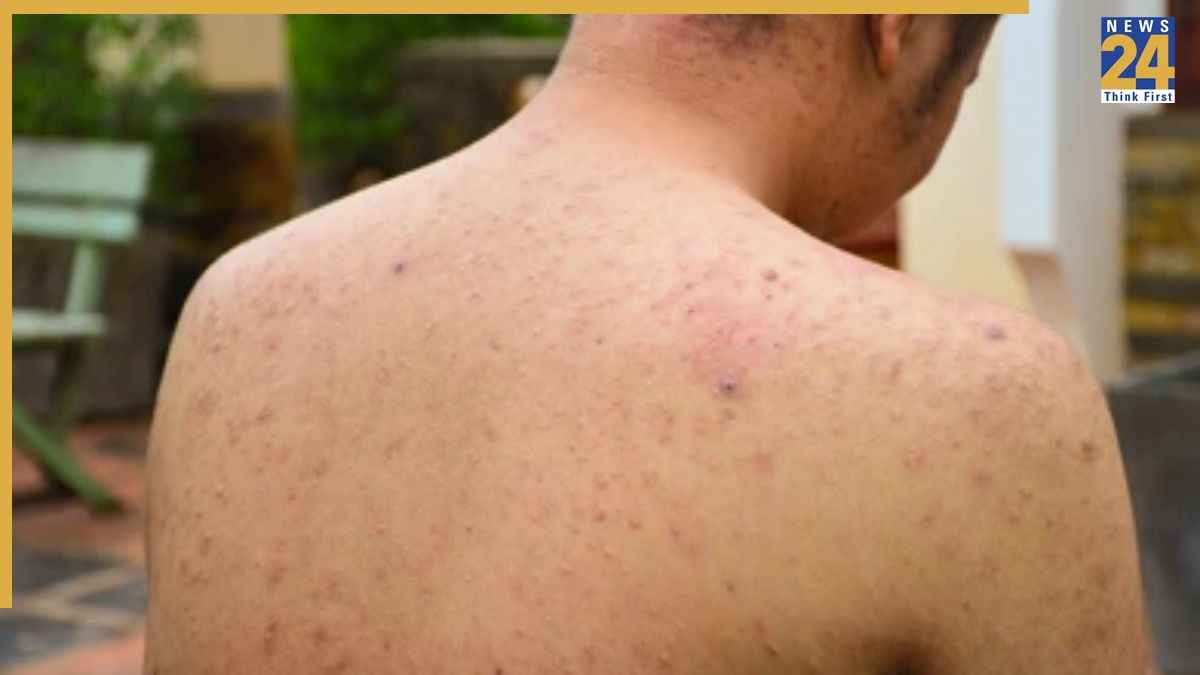अचानक शरीर में दर्द वाले दाने होने का क्या कारण है? जानिए कैसे पा सकते हैं छुटकारा