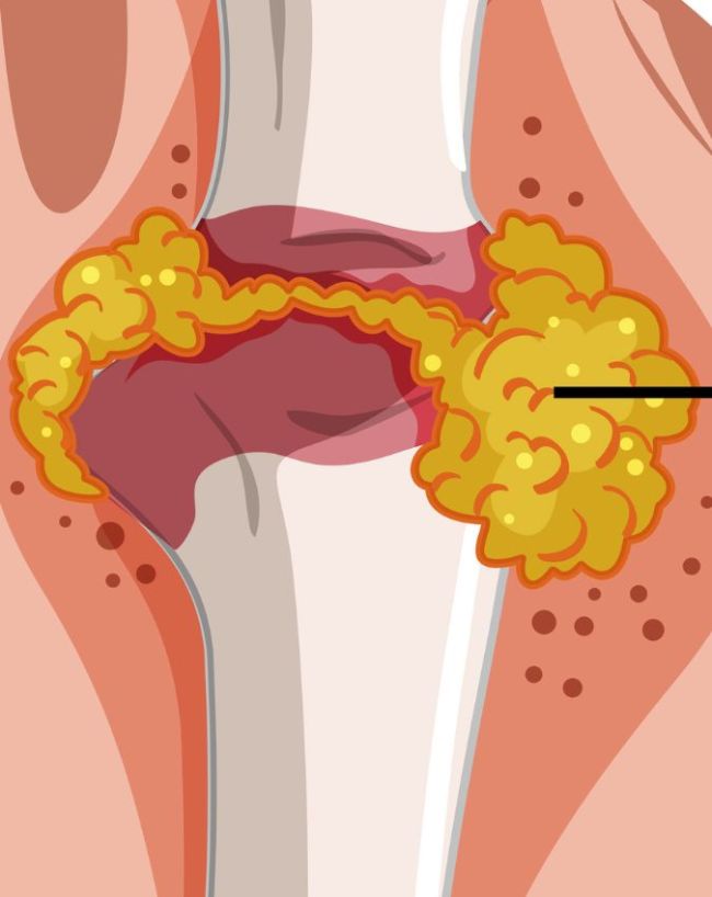 Foods That Increase Uric Acid-1-2-3-4-5-6